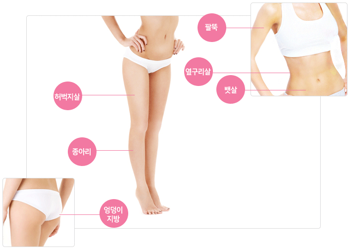 여성몸사진 엔더몰로지 주요시술 부위 마킹. 팔뚝,옆구리살,뱃살,허벅지살,종아리,엉덩이지방