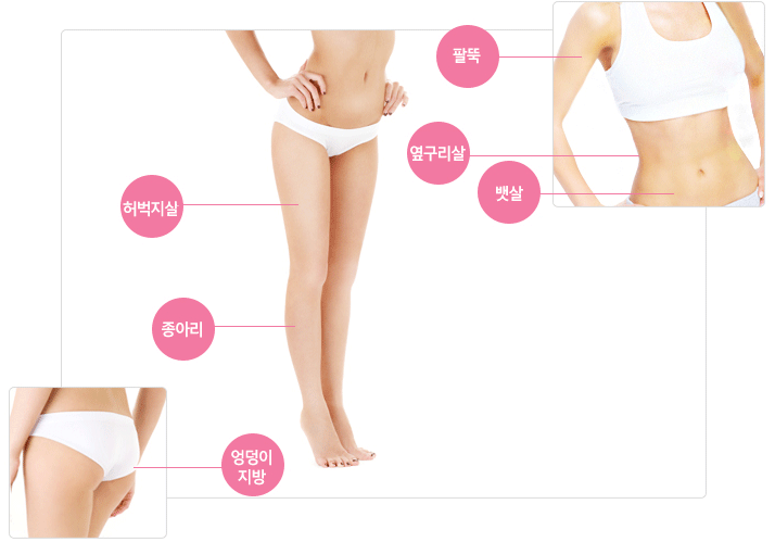 여성몸사진 지방분해주사 주요시술 부위 마킹. 팔뚝,옆구리살,뱃살,허벅지살,종아리,엉덩이지방